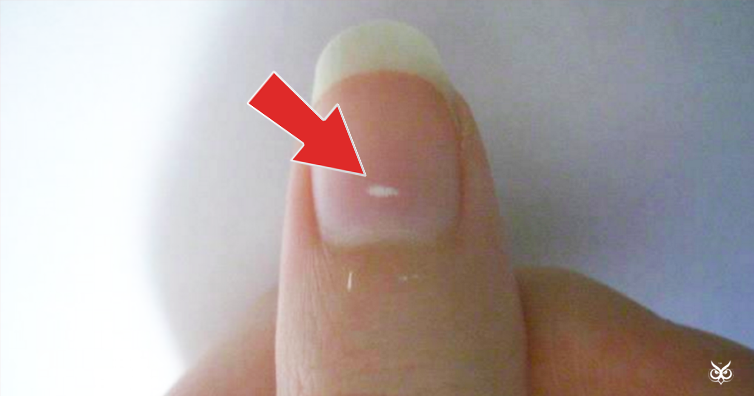 what-do-the-white-marks-on-your-fingernails-mean-white-spots-on